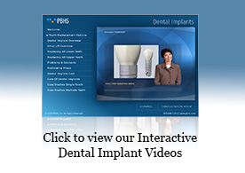 Presentación de implantes dentales