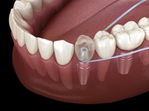 Detailed graphic depicting flossing to maintain and care for dental implants