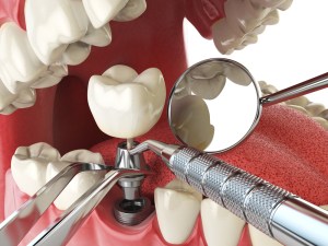 Gráfico de colocación de implantes dentales