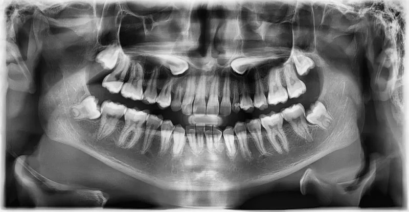 impacted canine x-ray