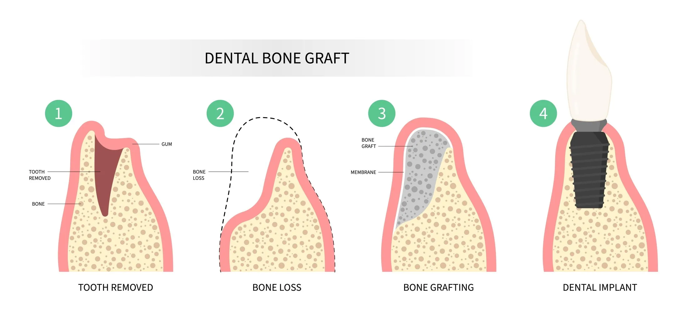 Bone Grafting Options for Dental Implants