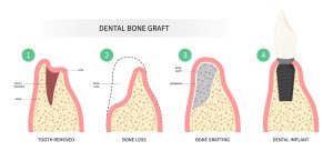 Oral Surgeon Tampa dental bone graft diagram