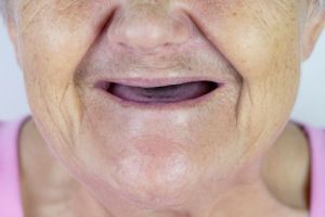 Jawbone Loss Image