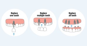 graphic of dental implant placement
