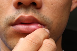 Man with cold sore on lip