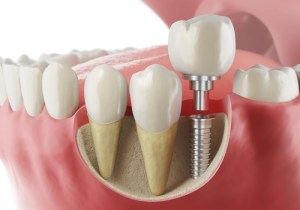 Implant and teeth in gums