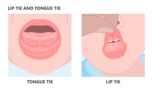 lip & tongue tie example pictures
