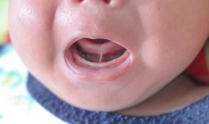 baby with tongue tie