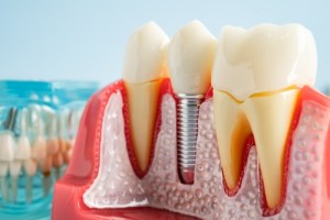 dental implants in gums mockup