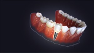Smile mockup with one dental implant